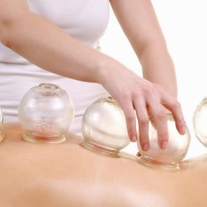 Cupping Treatment Cupping Treatment